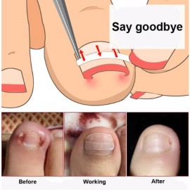 Batık Tırnak Bandı